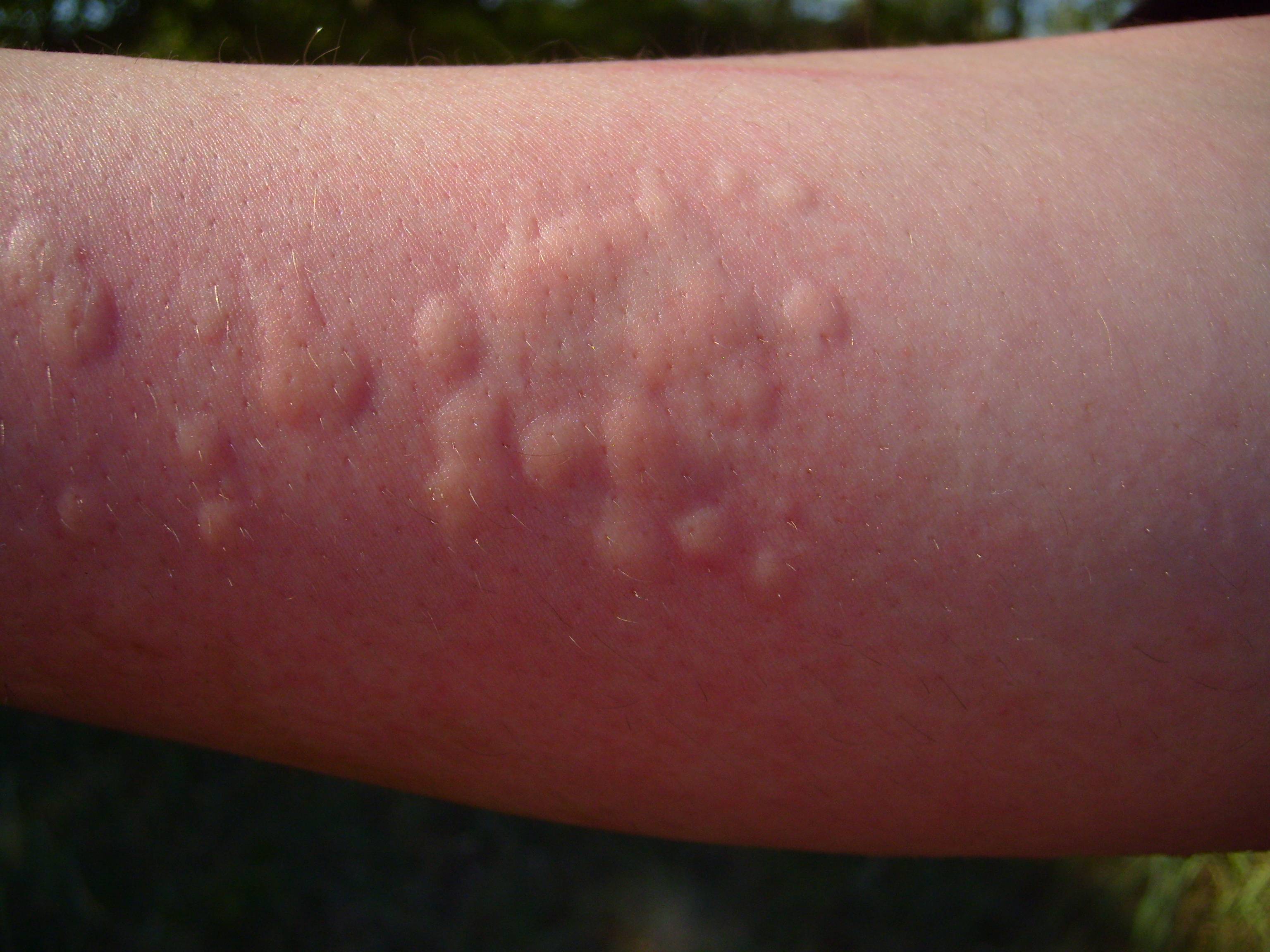 Small Itchy Eczema Bumps on Hands, Fingers, and Elbow