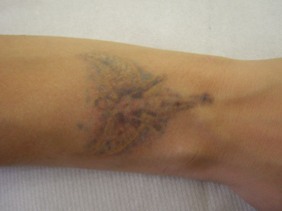 Rimozione tatuaggio - sedute intermedie
