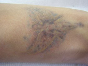 Rimozione tatuaggio - sedute intermedie